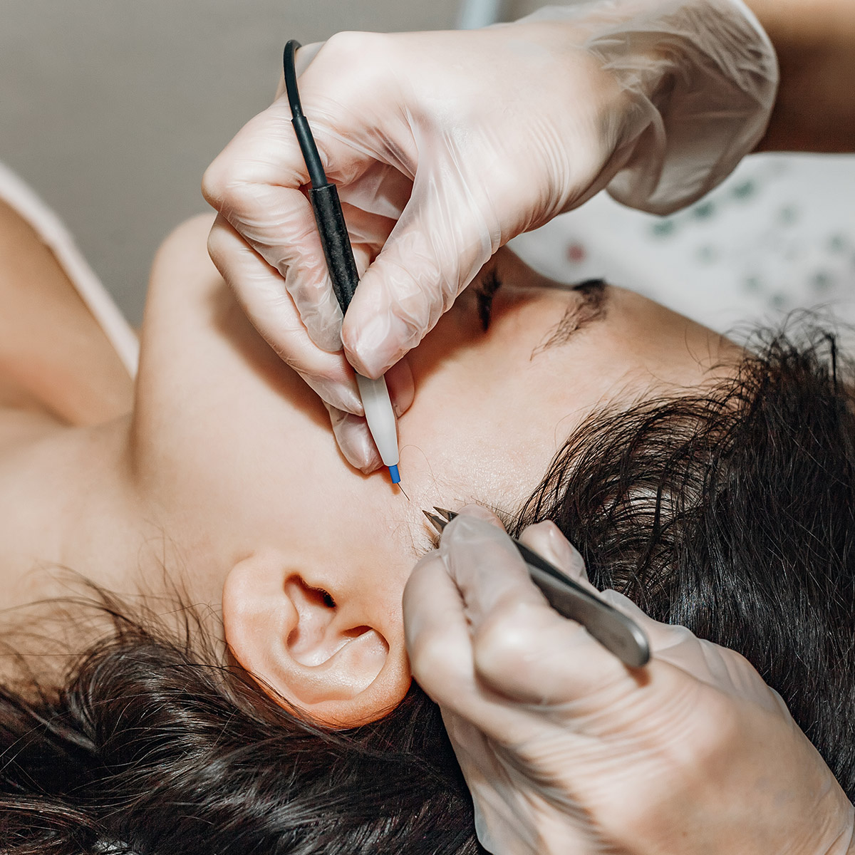 Electrolysis Laser Hair Removal