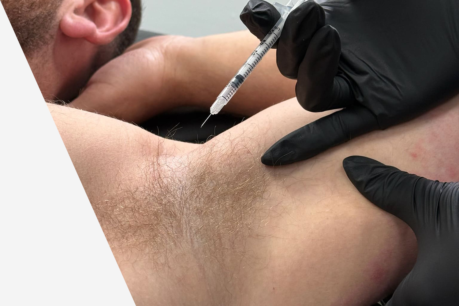 Botox for Sweating in Dubai